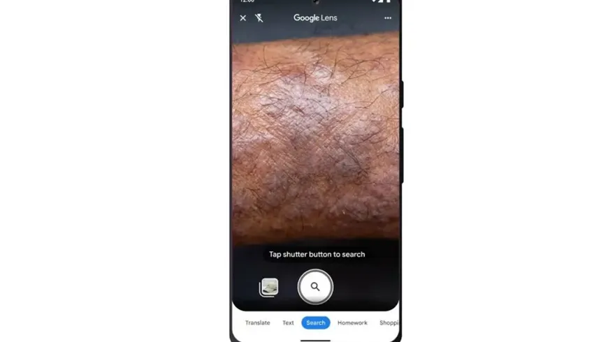 گوگل لنز دیگر می‌تواند بیماری‌های مختلف پوستی را تشخیص و درمان آن را توضیح دهد